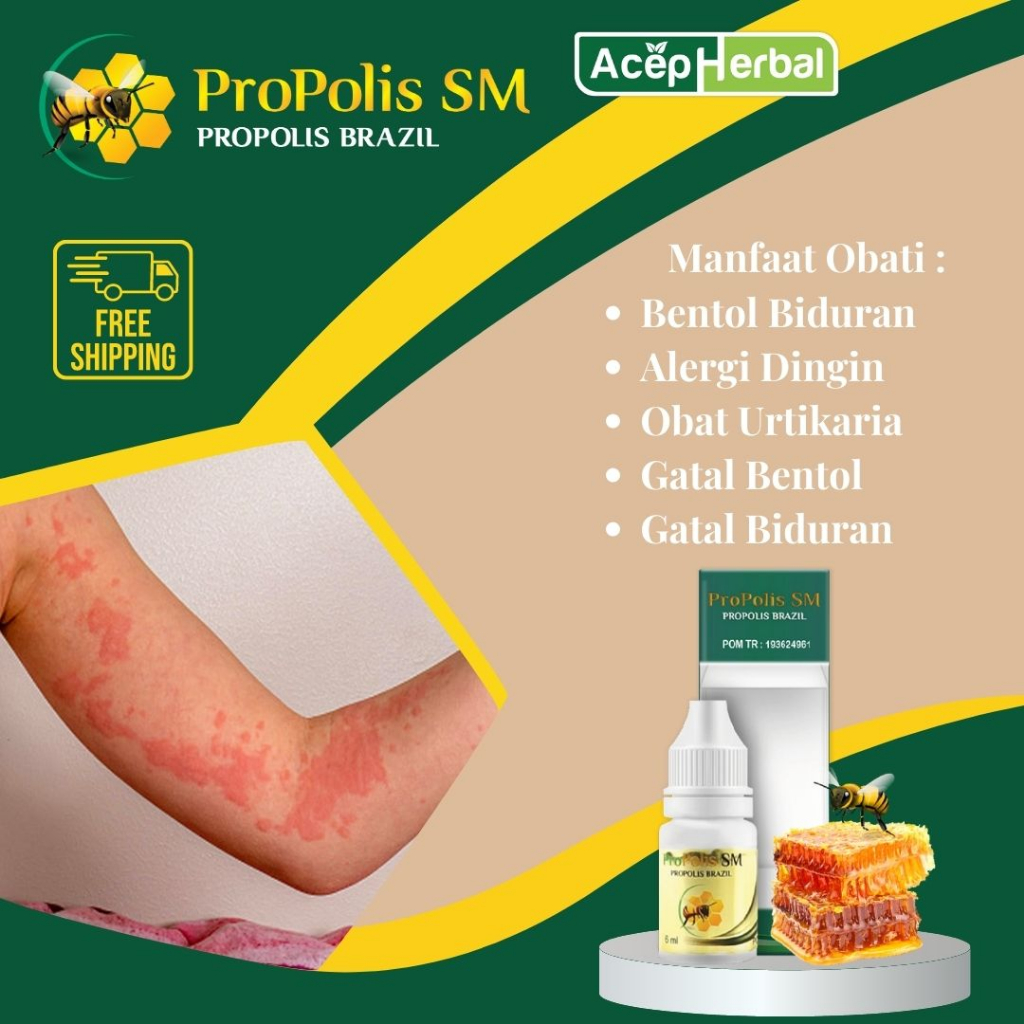 Obat Biduran - Obat Bentol Biduran, Obat Urtikaria, Obat Gatal Biduran, Obat Alergi Dingin, Obat Bid