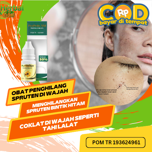 Obat Penghilang Spruten Di Wajah, Salep Menghilangkan Spruten Bintik Hitam / Coklat Di Wajah Seperti