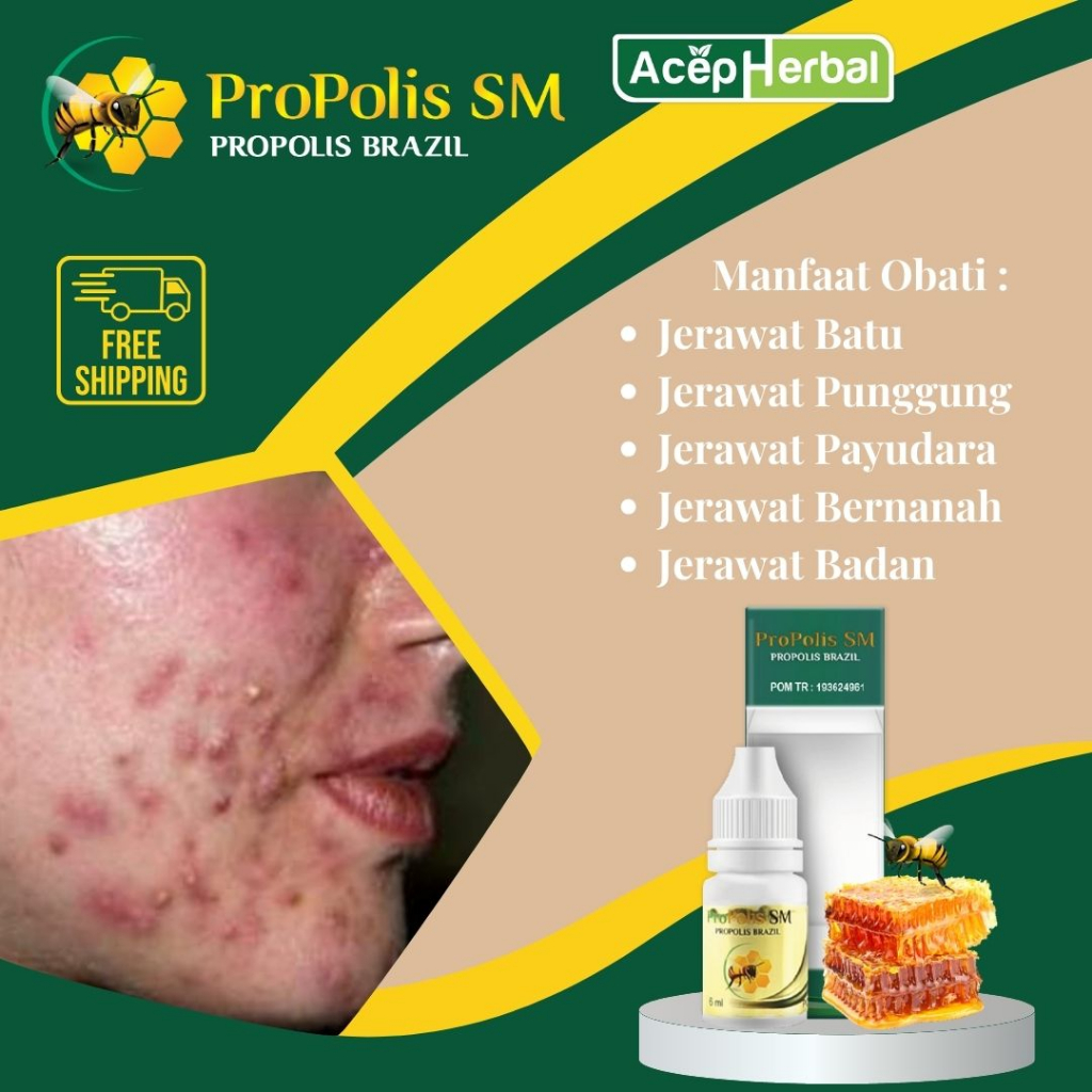 Obat Jerawat Batu - Obat Jerawat , Obat Jerawat Punggung, Obat Jerawat Di Payudara, Obat Jerawat Min