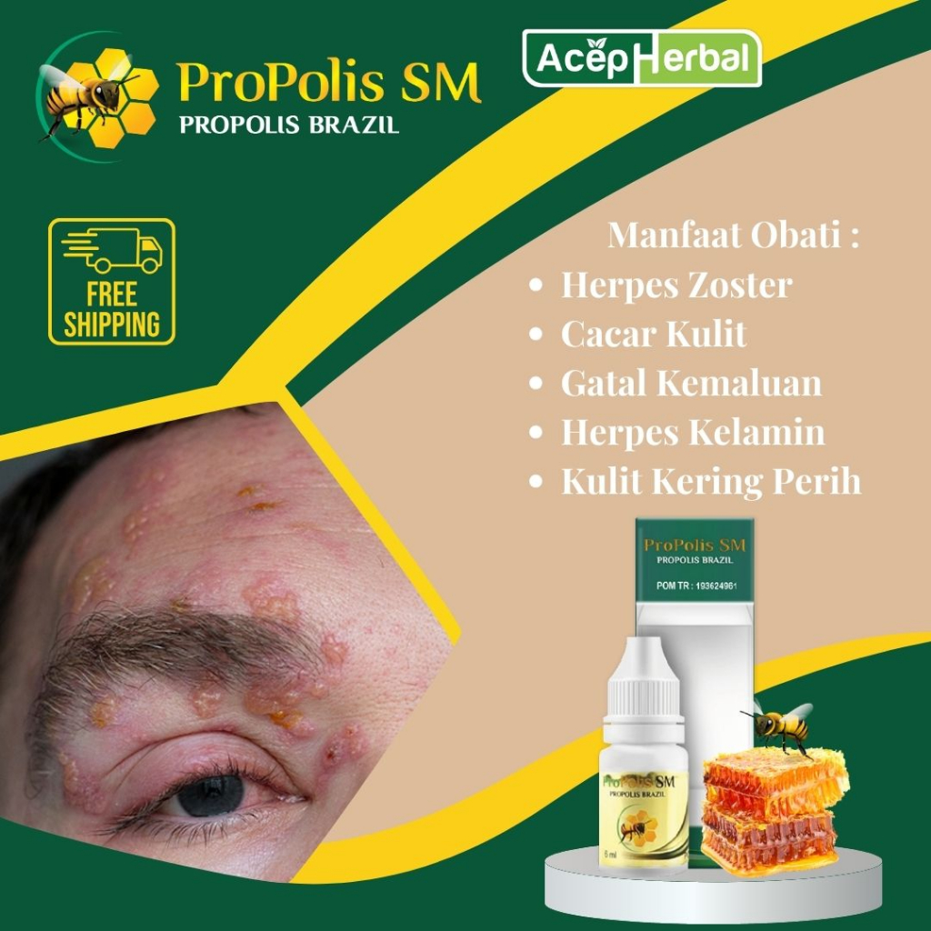Salep Oles Untuk Obat Herpes Atasi herpes di bibir, herpes zoster, cacar air, cacar api, ruam merah,