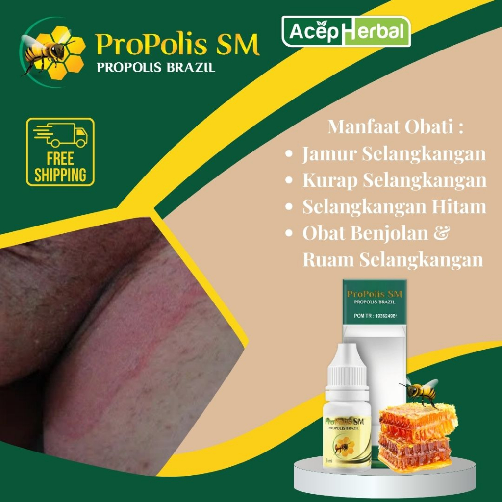 Obat Jamur Selangkangan, Kurap Selangkangan, Obat Selangkangan Hitam, Obat Gatal Selangkangan, Obat 