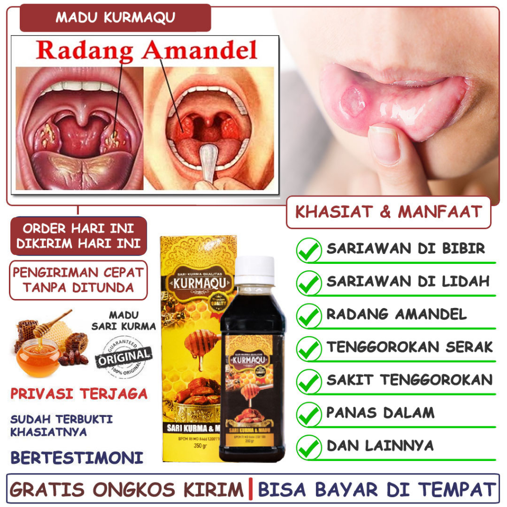 Obat Sariawan Di Bibir Mulut Lidah Panas Dalam Tenggorokan Serak Kering Mengganjal Amandel Anak Dan 