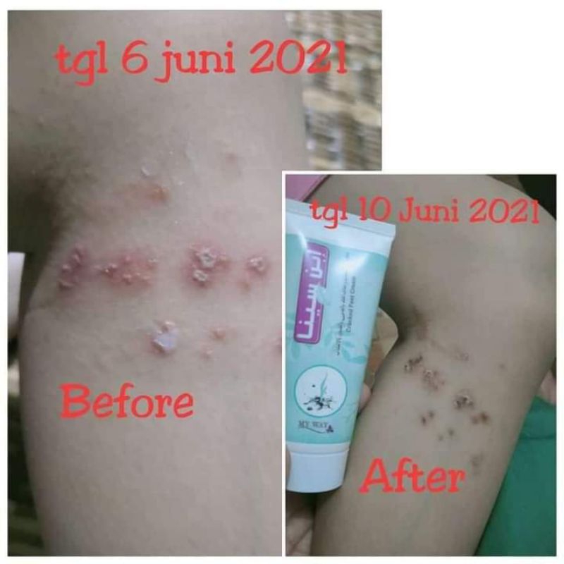 Ay00! My Way Ibnu Sina Cream Gatel Kaki Pecah-Pecah