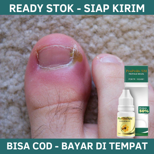 Obat Tetes Cantengan, Obat Cantengan Jempol Kaki, Obat Kuku Cantengan Bernanah, Obat Jamur Kuku, Oba