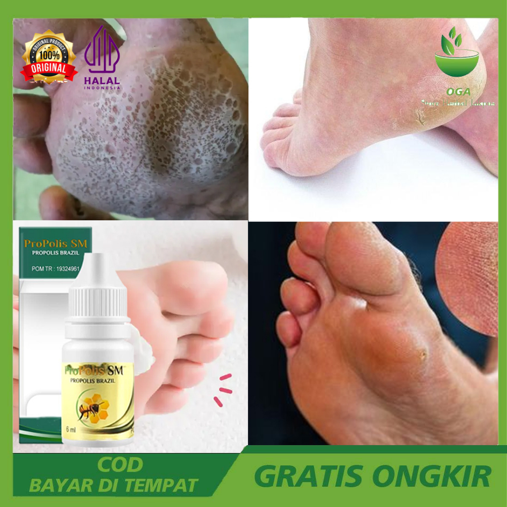 PROPOLIS Obat Telapak Kaki Bolong, Penghilang Telapak Kaki Bolong, Obat Tetes Kaki Bolong, Obat Oles