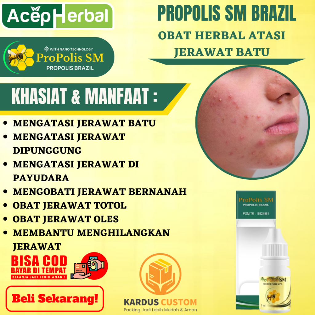 Obat Jerawat Batu Obat Jerawat , Obat Jerawat Punggung, Obat Jerawat Di Payudara, Obat Jerawat Minum