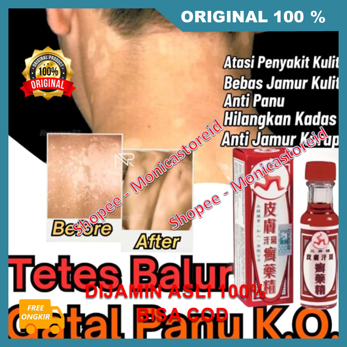 Tetes Balur Gatal Panu Obat Tradisional Tiongkok Atasi Penyakit Kulit , Panu, Kadas, Kurap Ampuh 100