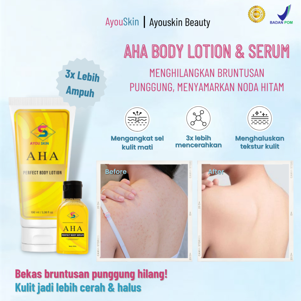 Penghilang bruntusan punggung, krim penghilang noda hitam bekas jerawat punggung, menghilangkan beka