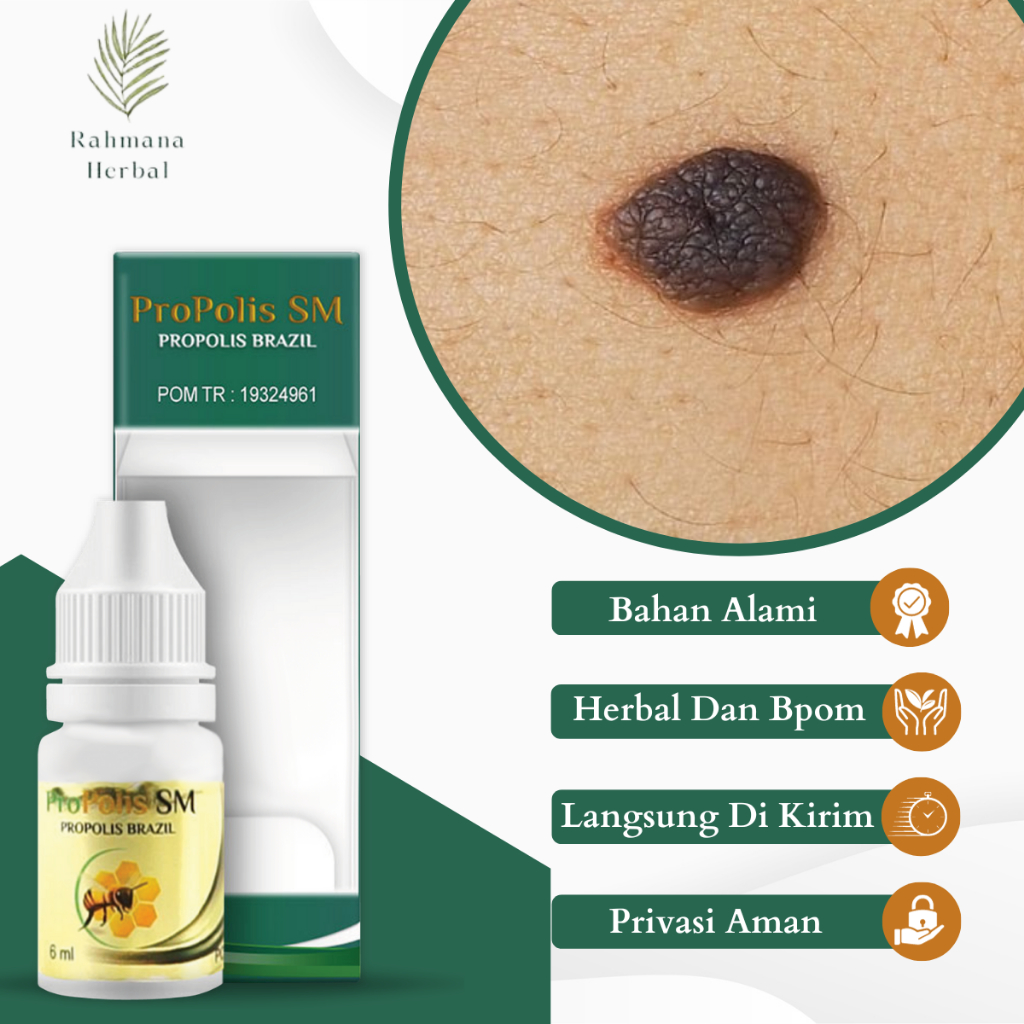 Obat Penghilang Tahi Lalat Obat Perontok Tahi Lalat Obat Tahi Lalat Hitam Obat Tahi Lalat Hidup, Oba