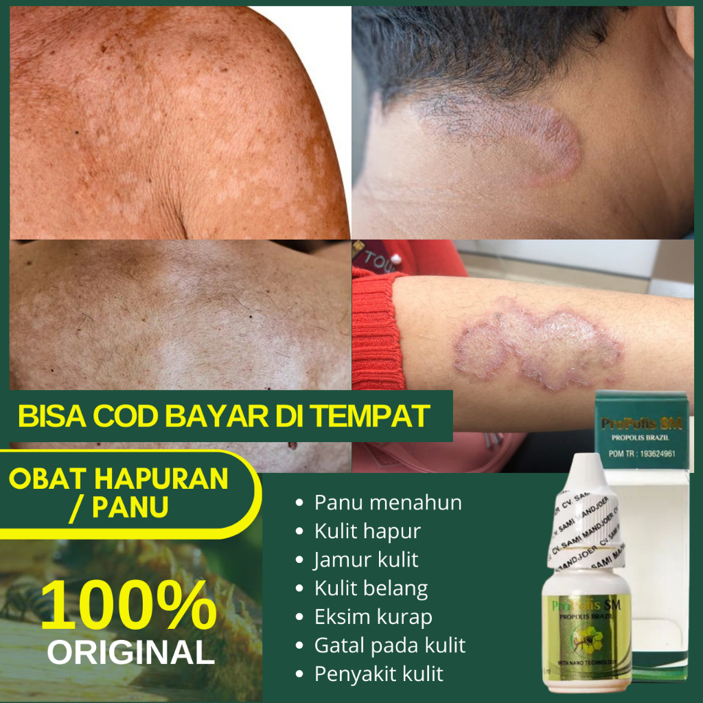 Obat Kulit Hapuran Panu Di Wajah, Penghilang Balas Bogo Membandel, Bercak Putih Di Muka - Salep Cair