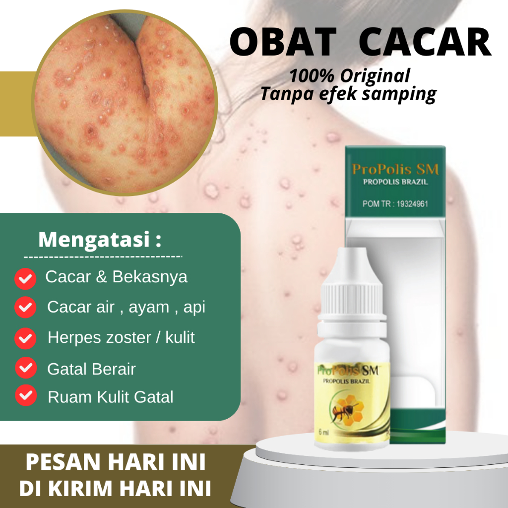 Propolis SM - Salep Cacar Tampek, Penghilang Cacar Api, Obat Kulit Bintik Berair, Obat Herpes Zoster