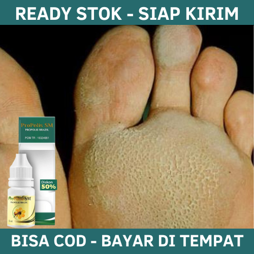 Obat Kaki Rayapan dan Bau, Obat kaki Rayapan, Obat Telapak kaki Bolong Bolong, Obat Telapak Kaki Ray
