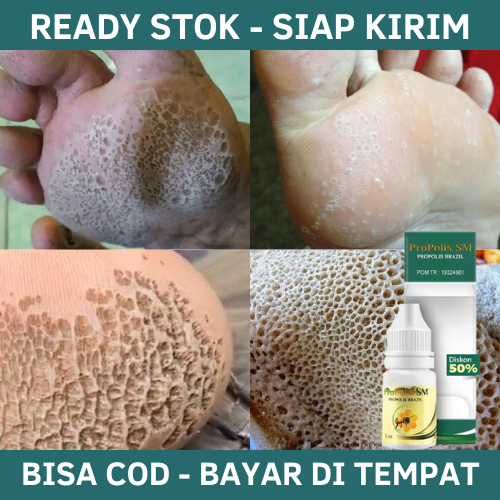 Obat Kaki Rayapan, Obat Kaki Rayapan dan Bau, Obat Kaki Rayapan Telapak Kaki, Obat Telapak kaki Bolo
