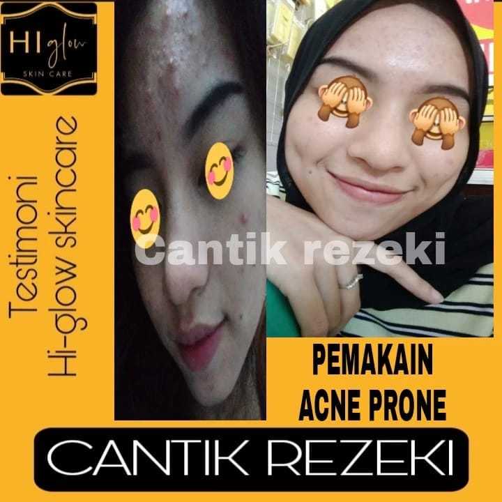 Hi Glow Skincare Paket Premium Acne ( AC1 ) / Bahan Premium diformulasikan khusus untuk wajah Berjerawat dan berminyak