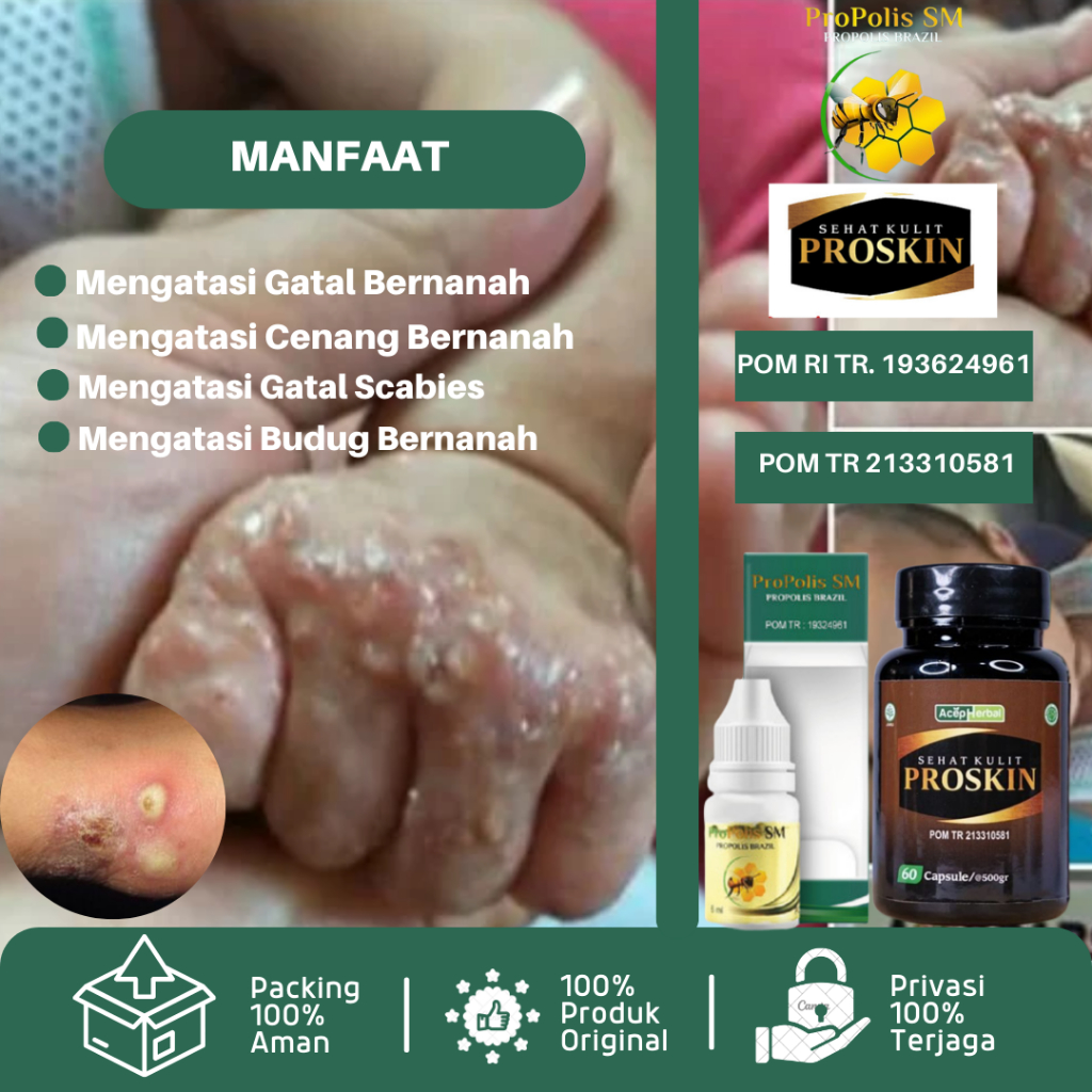Obat Cenang Bernanah, Obat Gatal Bernanah, Obat Gudik Manusia, Salep Scabies, Obat Koreng Bernanah, 