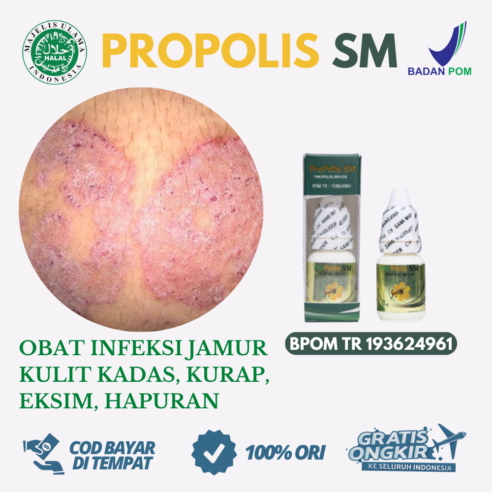 Obat Herbal Untuk Jamur Kulit, Obat Kudis, Obat Kurap, Obat Panu, Obat Hapur - Popolis SM Brazilia