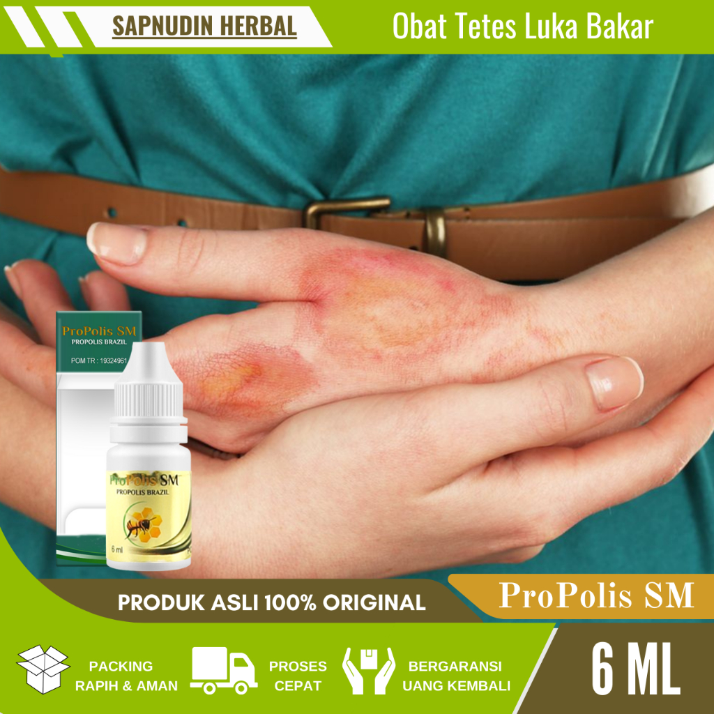 Obat Luka Bakar, Obat Tetes Luka Bakar, Obat Pengering Luka Bakar, Obat Luka Parah, Obat Luka Basah 
