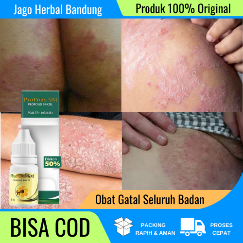Obat Gatal Seluruh Badan, Obat Gatal Selangkangan Dan Kemaluan, Obat Gatal Kelamin, Obat Herbal Gata