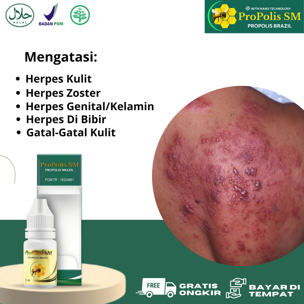 Obat Herpes, Obat Herpes Zoster, Obat Herpes kulit, Obat herpes bibir, Obat Herpes Genital, Obat pen