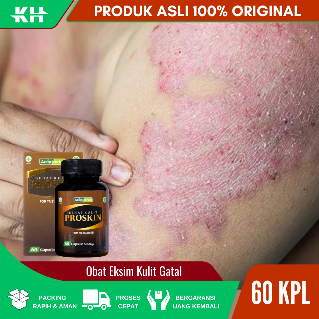 Obat Eksim Kulit Gatal Untuk Jamuran Di Kaki Tangan Gatal2 Kering Bersisik Gatal Menahun Psoriasis D