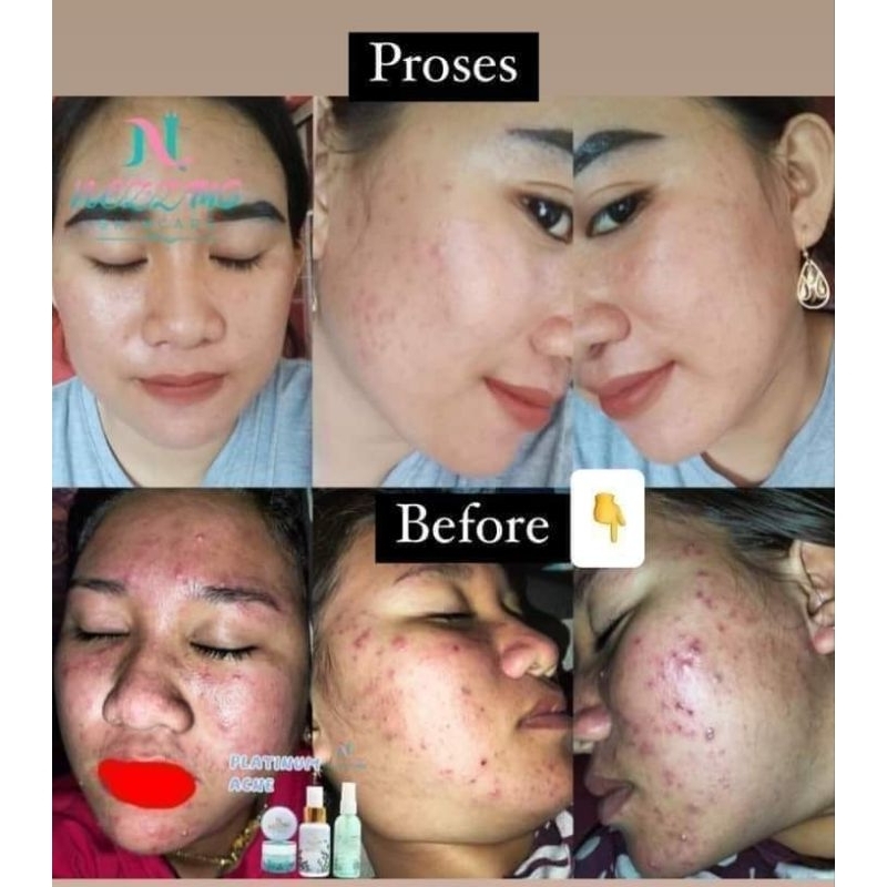 NEZZMG SKINCARE Platinum Acne