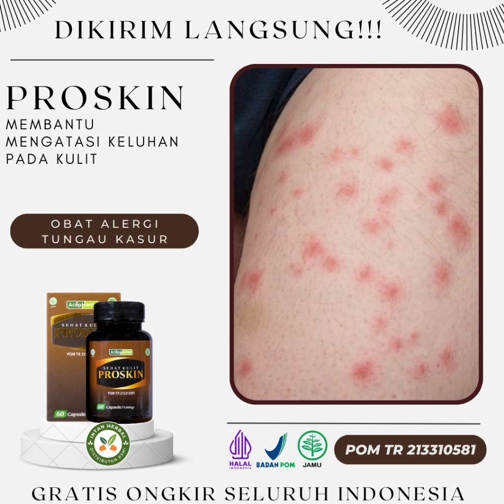 Proskin - Obat Alergi Tungau Kasur, Alergi Kutu Kasur, Alergi Tungau Debu, Penghilang Bekas Gigitan 