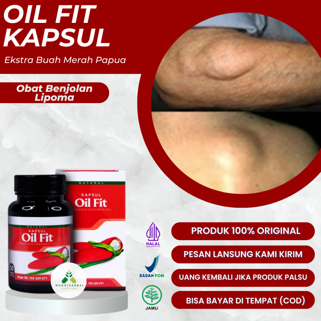 Oil Fit Kapsul - Obat Lipoma, Benjolan Lipoma, Penghancur Lipoma, Lipoma Di Leher, Lipoma Di Kepala,