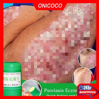 Skin Psoriasis Eczma Cream for All Kinds of Skin Problems Chinese Herbal Antibacterial Ointment Skin