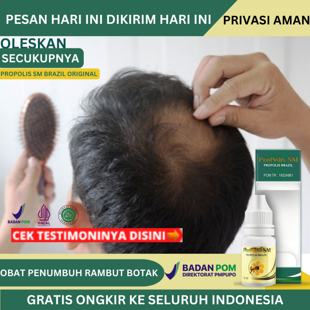 Obat Penumbuh Rambut Botak Di Tengah, Obat Alopecia Areata, Obat Kebotakan Pada Rambut Kepala, Obat 