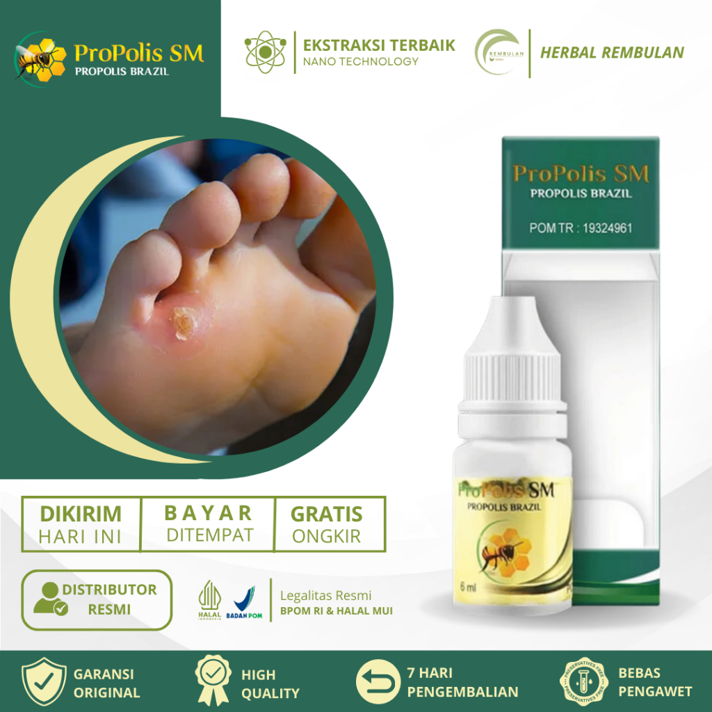 Obat Mata Ikan, Obat Mata Ikan Di Telapak Kaki, Obat Mata Ikan di Kaki & Tangan, Obat Perontok Mata 