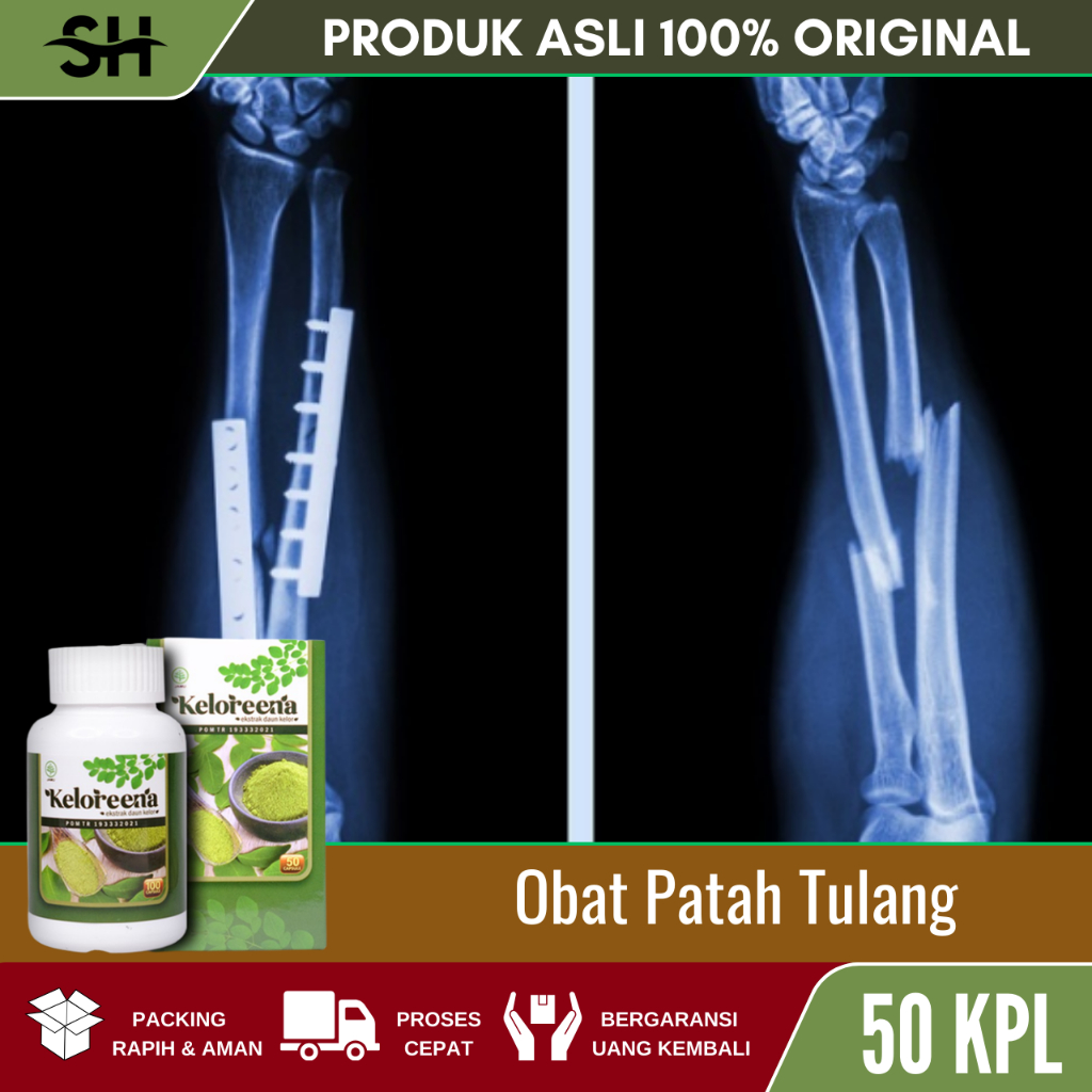 Obat Patah Tulang, Tulang Retak, Tulang Bergeser, Penyambung Patah Tulang, Faktur Tulang, Tulang Ker