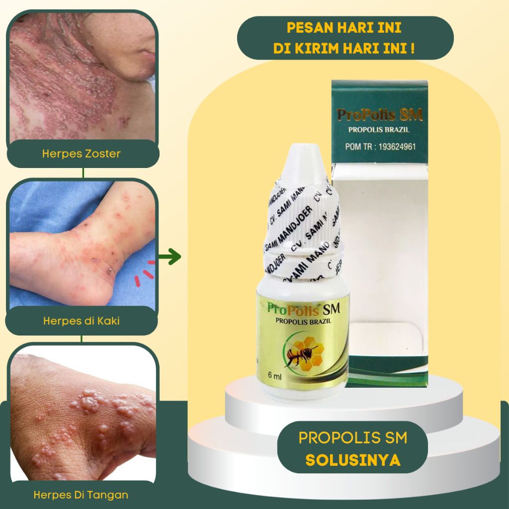 Obat Herpes - Obat Gatal Kulit Herpes - Obat Herpes Genital - Obat Herpes Zoster - Obat Kulit Herpes