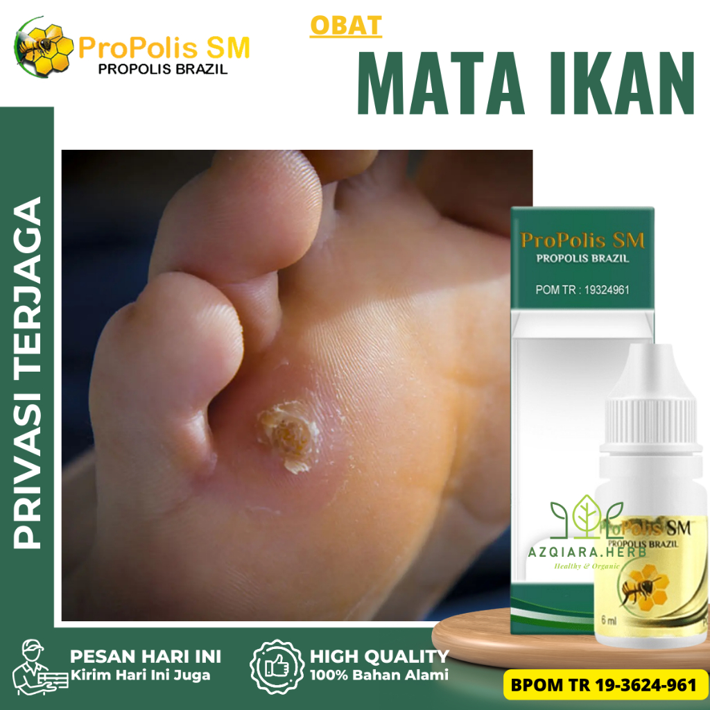 Obat Mata Ikan, Obat Perontok Mata Ikan di Telapak Kaki & Tangan, Obat Penghilang mata ikan, Obat Be