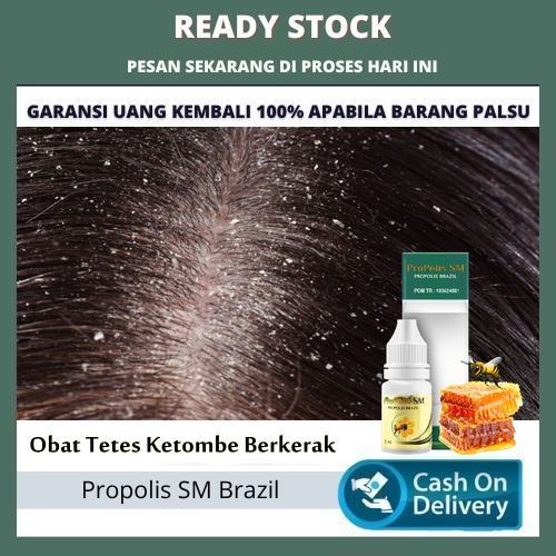 Obat Tetes Ketombe Berkerak - Herbal Penghilang Ketombe Parah, Kulit Kepala Bersisik, Salep Psoriasi