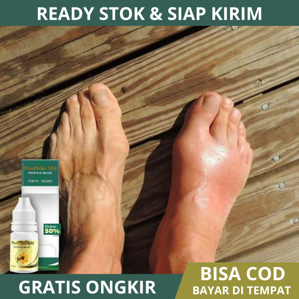 Obat Asam Urat, Obat Rematik, Obat Rematik Asam Urat Sendi Tulang, Obat Herbal Asam Urat, Obat Asam 