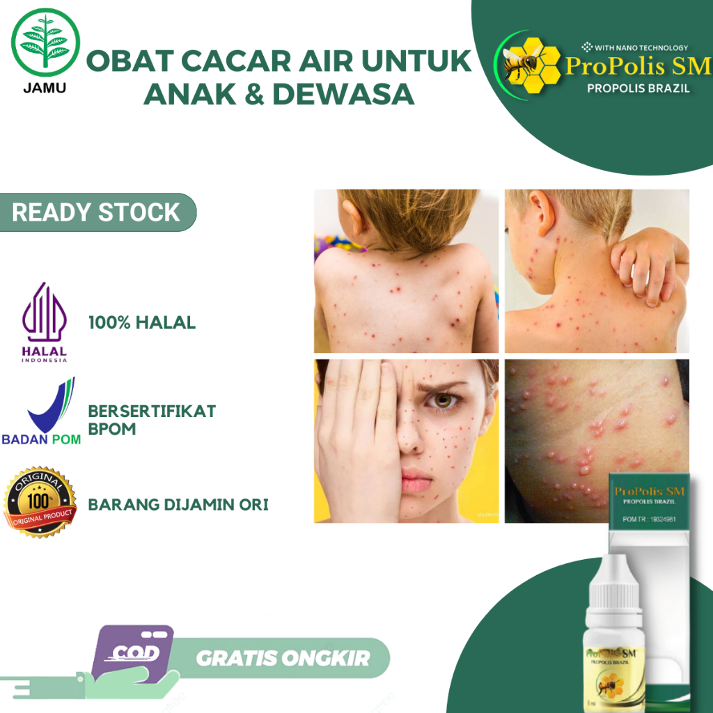 Obat Cacar Air Untuk Anak Dewasa Gatal Bintik Berair Ruam Berair Tampek Anak Herpes Campak Bintil Ku