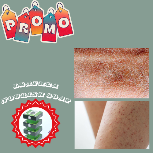 Obat Kulit Kering Bersisik - Obat Keratosis Pilaris - Keratosis Seboroik Seborrheic - Penyakit Kulit