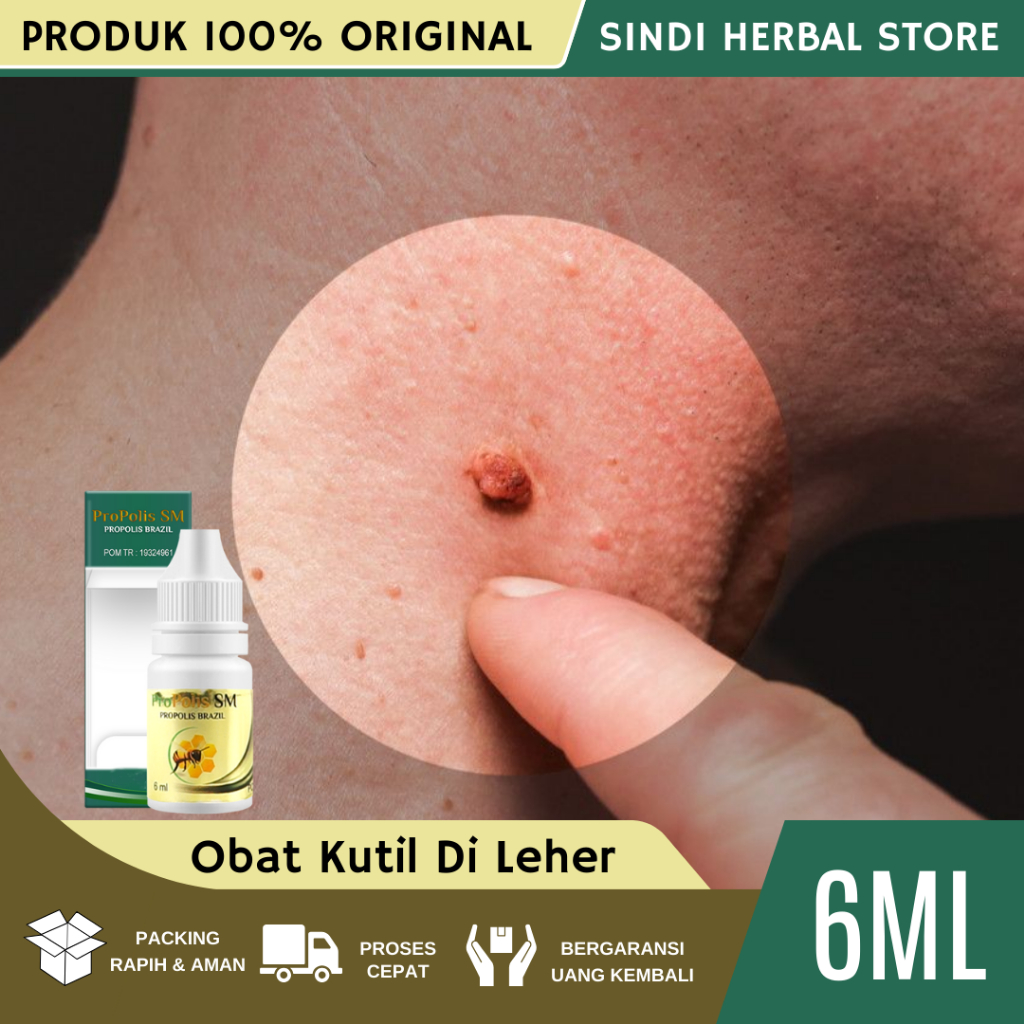 Obat Kutil Di Leher - Obat Oles Perontok Kutil Di Leher - Obat Penghilang Kutil Di Leher - Obat Pero