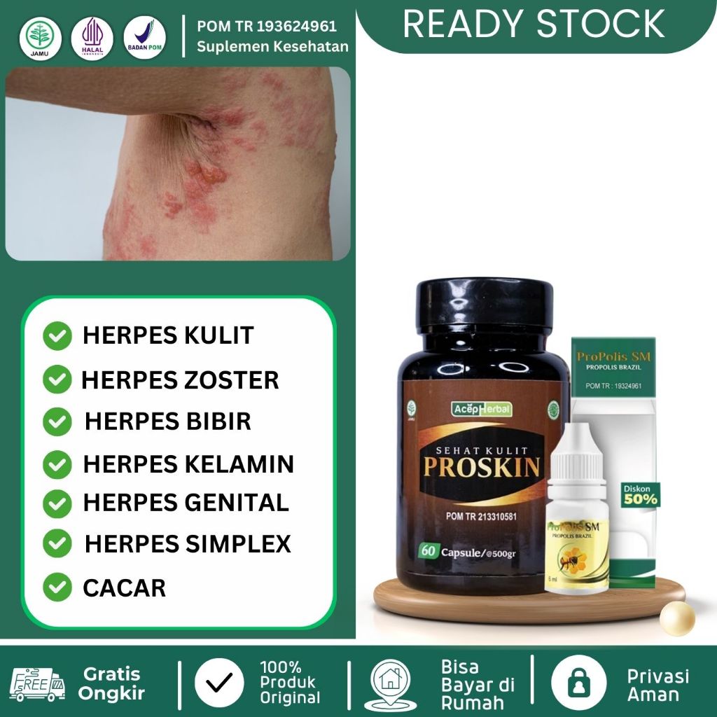 Obat Herpes Kulit, Obat Herpes Zoster, Obat Herpes Bibir, Obat Herpes Kelamin, Herpes Genital, Obat 
