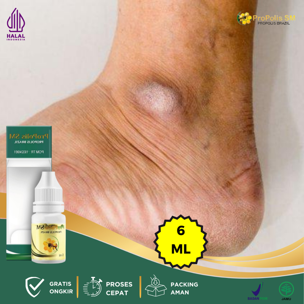 Obat Mata Kaki Hitam, Obat Pemutih Mata Kaki Hitam, Obat Oles Mata Kaki Hitam, Obat Kaki Kapalan, Ob