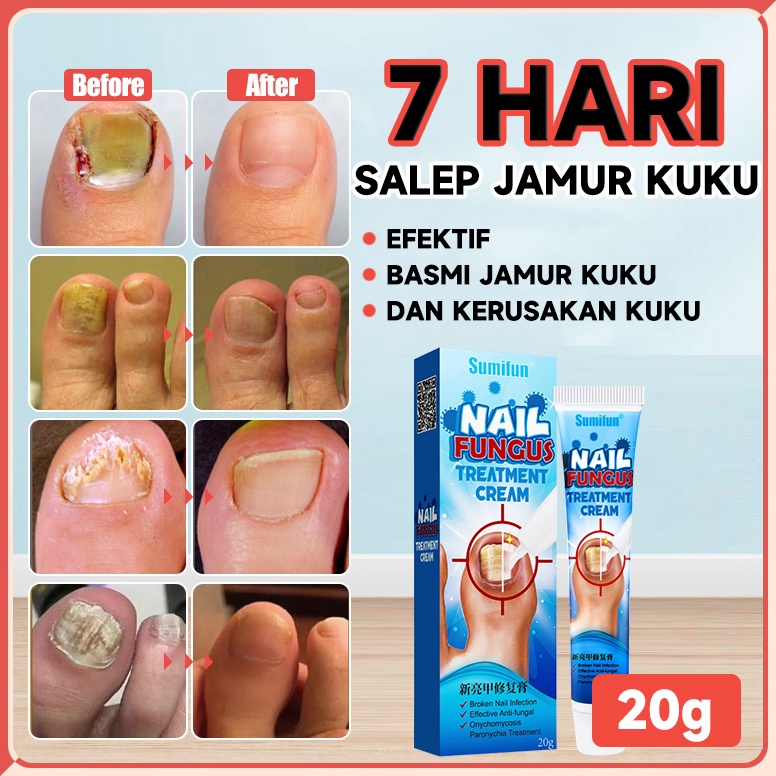 KUALITAS TERJAMIN Obat jamur kuku Obat kuku jamur dan rusak Salep jamur kuku 2g 1 Cairan penekan bak