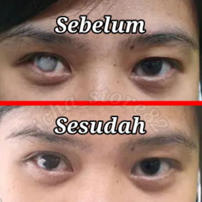 Lensa mata cacat Softlens prosthetic iris Lensa mata cacat menutupi iris putih dan pupil Softlen mat