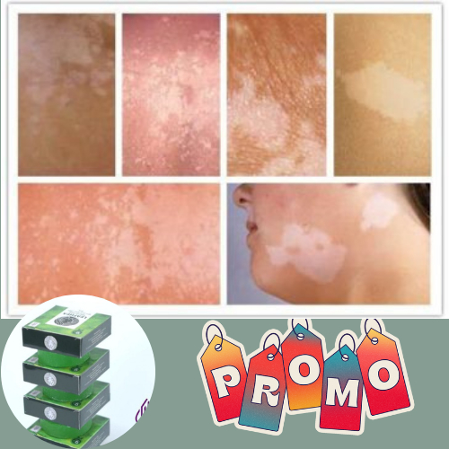 Obat Kulit Panu Paling Ampuh, Obat Panu Anak Di Wajah, Obat Hapur Di Wajah, Obat Hapur Anak & Dewasa