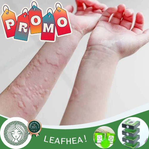 Sabun Oles Kulit Gatal Alergi Biduran Kaligata, Obat Alergi Makanan, Alergi Cuaca, Dan Alergi Debu, 