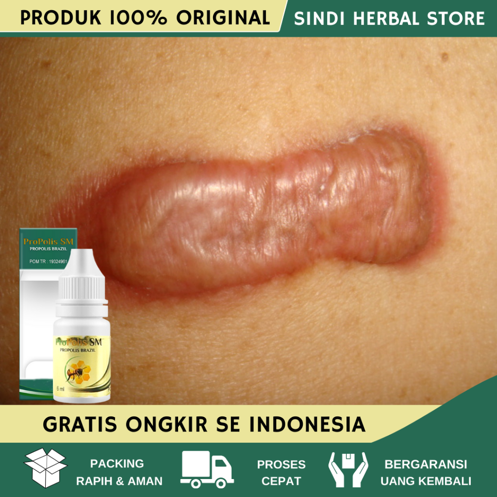 Obat Keloid, Obat Keloid Daging Tumbuh, Obat Keloid Bekas Luka, Obat Keloid Menahun, Obat Keloid Men