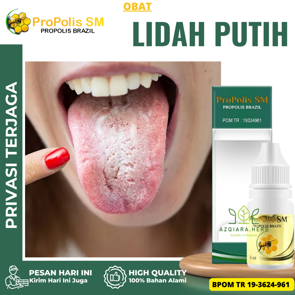 Obat Lidah Putih, Obat Lidah Berjamur, Obat Kandidiasis Mukokutan, Obat Penghilang Bercak Putih Dili