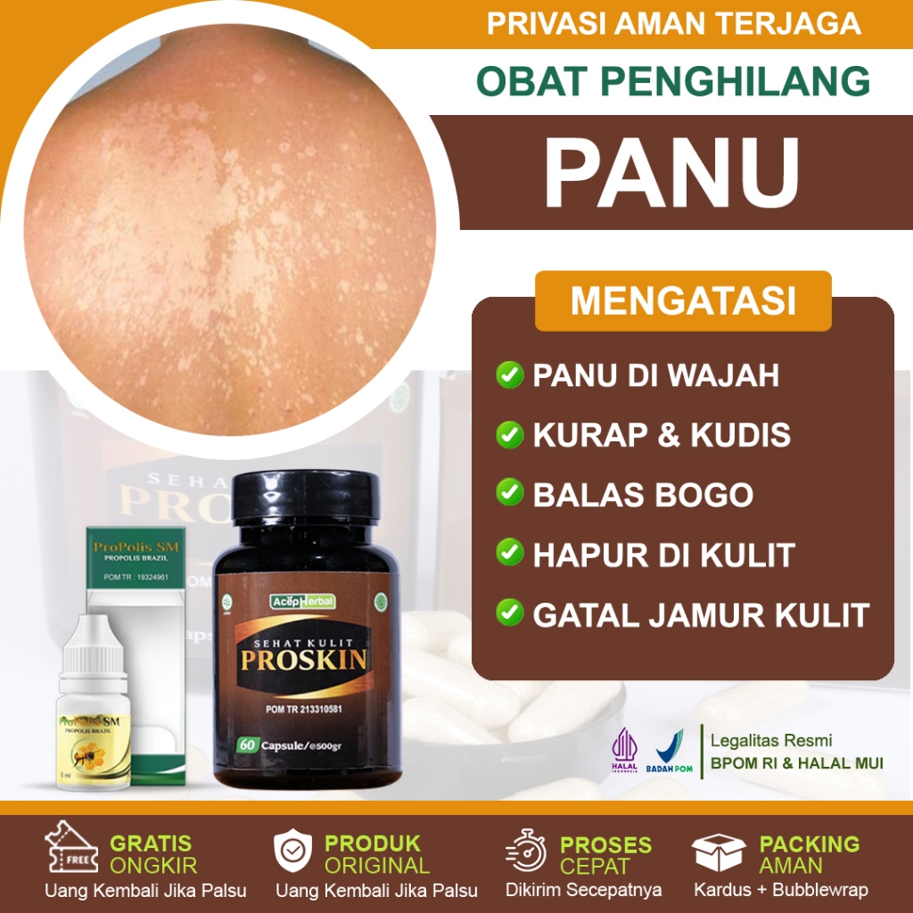 Obat Panu Cair Kurap Kadas Salep Penghilang Panu Hitam Di Wajah Hapur Gatal Jamur Kulit Panuan Balas
