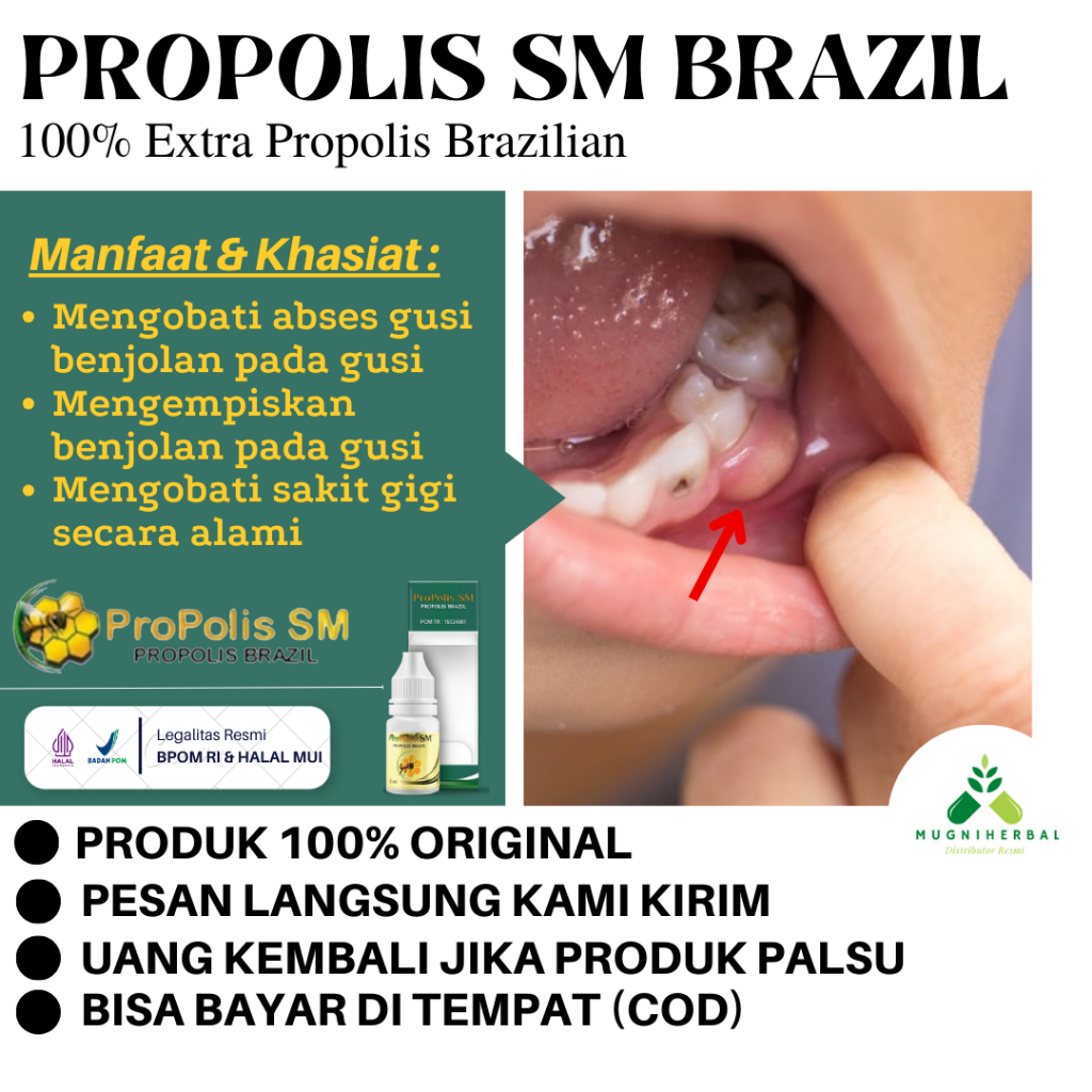 Propolis SM - Obat Abses Gigi, Infeksi Akar Gigi, Pulpitis, Pulpa, Radang Gusi, Gusi Bengkak, Infeks