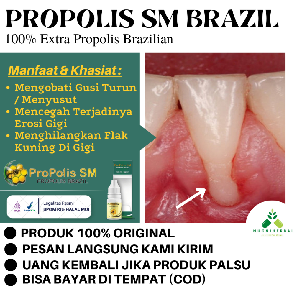 Propolis SM - Obat Gusi Turun, Gusi Bengkak, Radang Gusi, Gusi Turun Ke Bawah, Gingivitis, Gusi Berd