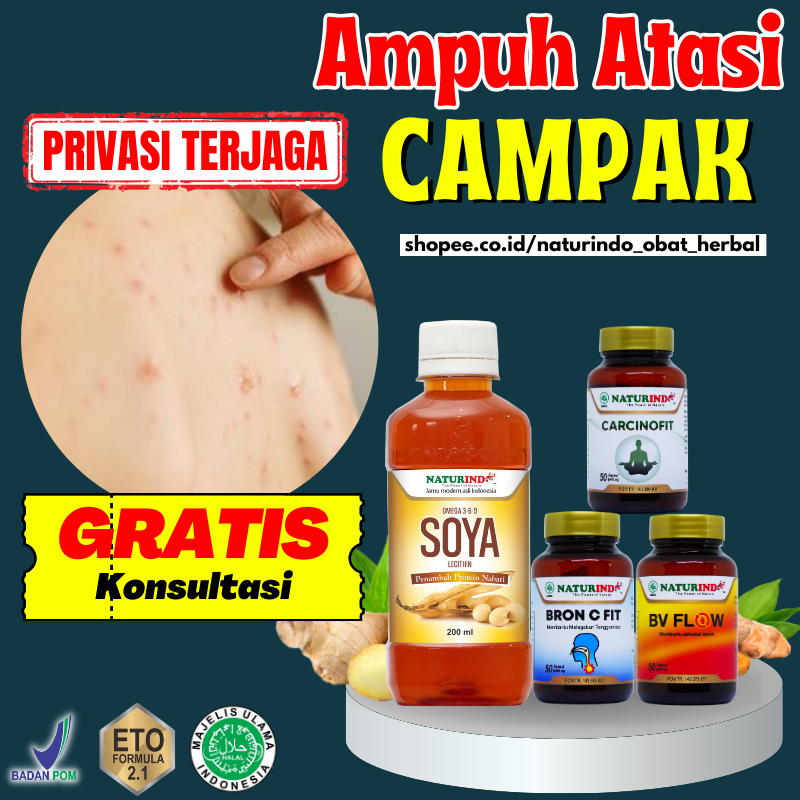 Obat Campak Gabak Rubela Scabies Gudik Gatal Gatel Tampek Skabies Manusia Kadas Korengan Koreng Gata